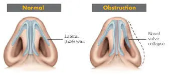 Breathe Right Nasal Strips - Extra Strength TAN